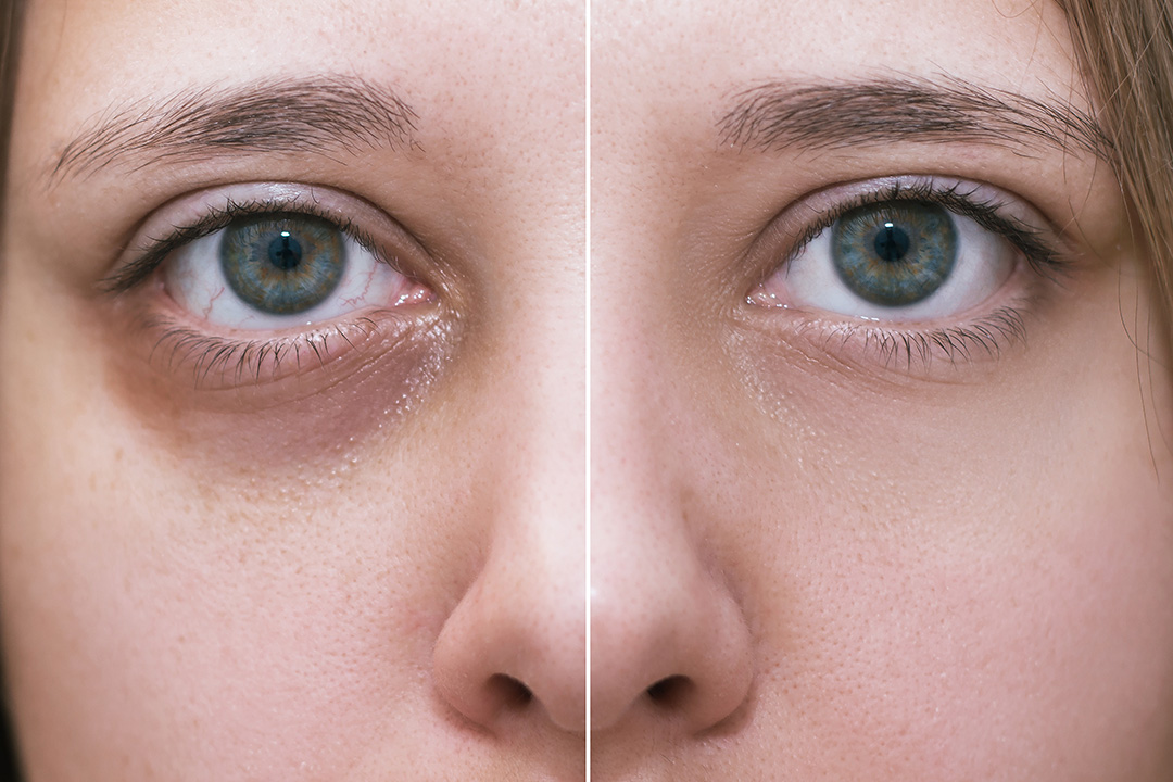 Getting Rid Of Dark Circles Under Your Eyes Well Help You